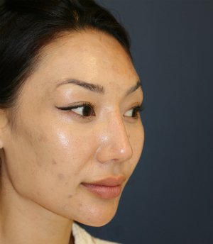 Nose Revision 25 - before - oblique