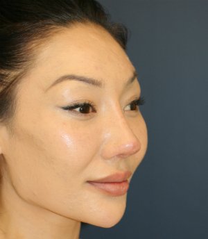 Nose Revision 25 - after - oblique