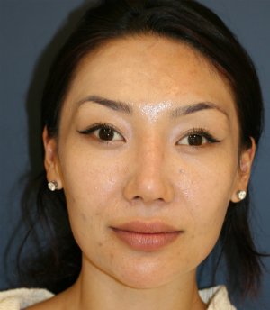 Nose Revision 25 - before - side