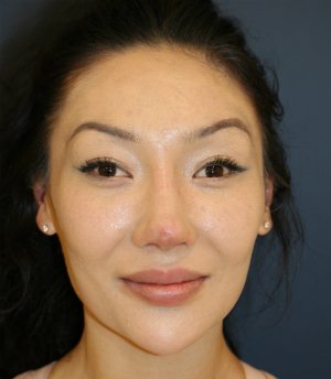 Nose Revision 25 - after - side