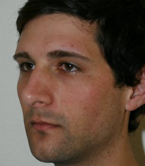 Nose Revision Male 5 - before - front