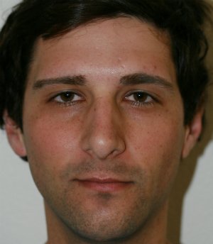 Nose Revision Male 5 - before - oblique