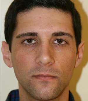 Nose Revision Male 5 - after - oblique