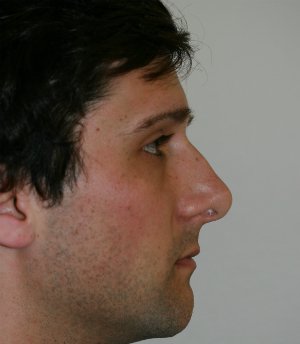 Nose Revision Male 5 - before - right side