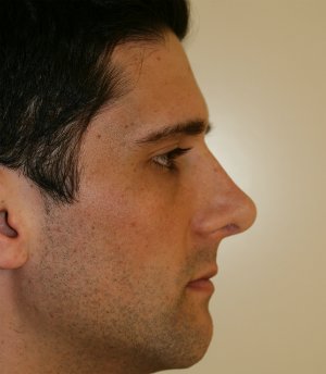 Nose Revision Male 5 - after - right side