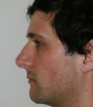 Nose Revision Male 5 - before - left side