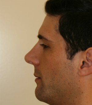 Nose Revision Male 5 - after - left side