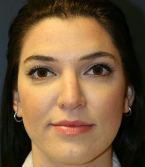 Revision Rhinoplasty 8 - before - front