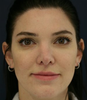 Revision Rhinoplasty 8 - after - front