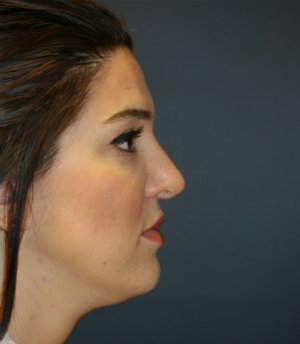 Revision Rhinoplasty 8 - before - side