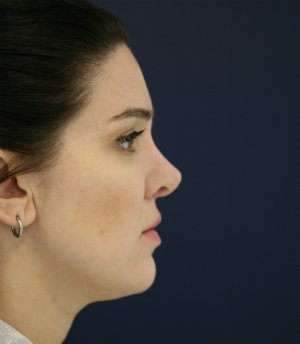 Revision Rhinoplasty 8 - after - side