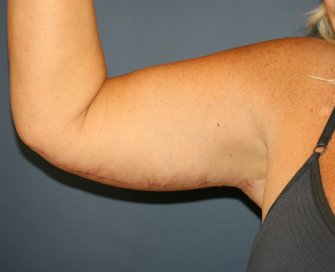 Arm Lift San Diego 29 - after - front