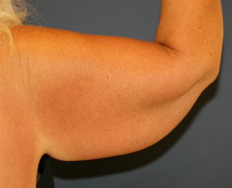 Arm Lift San Diego 29 - before - back