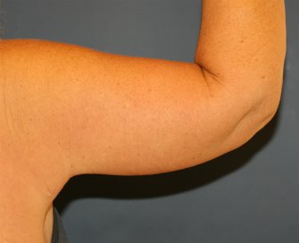 Arm Lift San Diego 29 - after - back