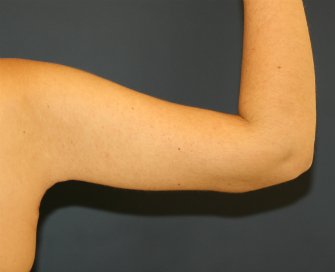 Arm Reduction 33 - after - front