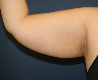 Arm Reduction 33 - before - back
