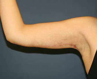 Arm Reduction 33 - after - back