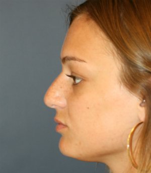 Rhinoplasty San Diego 134 - before - front