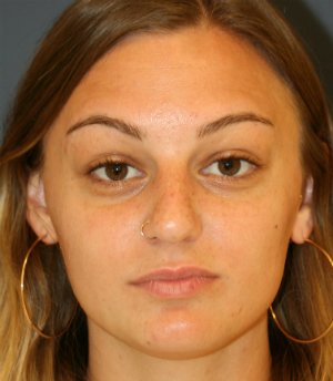 Rhinoplasty San Diego 134 - before - oblique