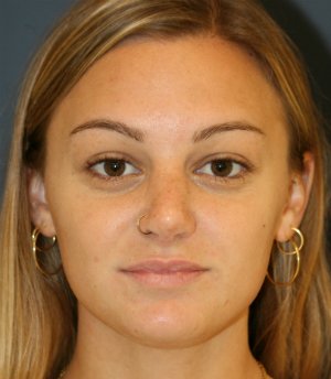 Rhinoplasty San Diego 134 - after - oblique