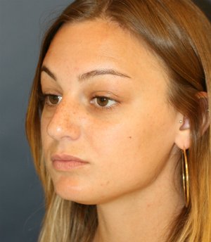 Rhinoplasty San Diego 134 - before - side
