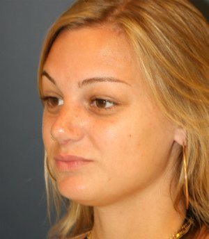 Rhinoplasty San Diego 134 - after - side