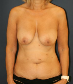 Mommy Makeover 50 - before - oblique