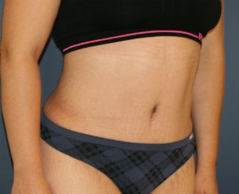 Tummy Tuck San Diego 145 - after - front