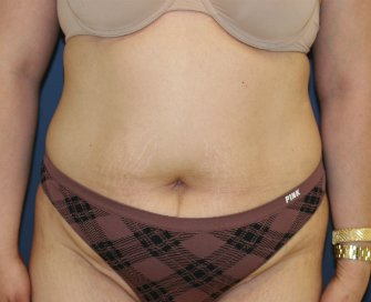 Tummy Tuck San Diego 145 - before - oblique