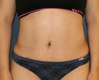 Tummy Tuck San Diego 145 - after - oblique