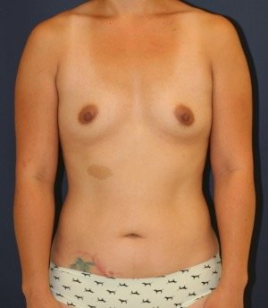 Mommy Makeover 51 - before - front