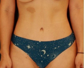 Tummy Tuck San Diego 146 - after - front