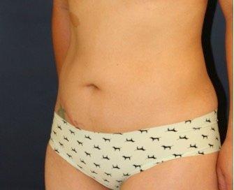 Tummy Tuck San Diego 146 - before - oblique