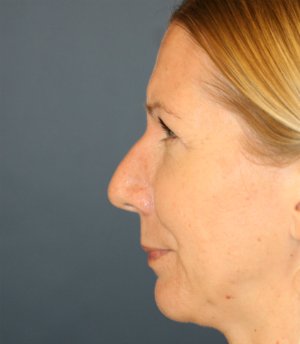Rhinoplasty San Diego 135 - before - front