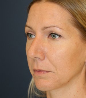 Rhinoplasty San Diego 135 - before - oblique