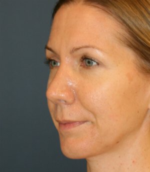 Rhinoplasty San Diego 135 - after - oblique