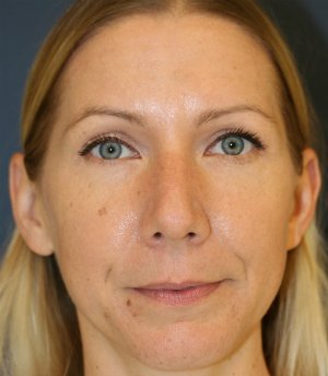 Rhinoplasty San Diego 135 - before - side