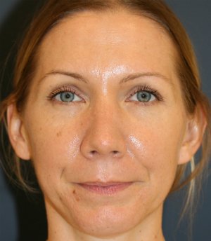 Rhinoplasty San Diego 135 - after - side