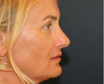 Rhinoplasty San Diego 136 - after - front
