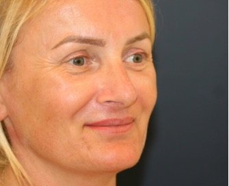 Rhinoplasty San Diego 136 - after - oblique