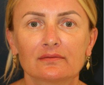 Rhinoplasty San Diego 136 - after - side