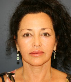 Eyes, Face and Neck - after - front