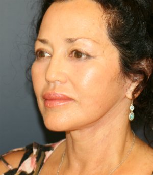 Eyes, Face and Neck - after - oblique