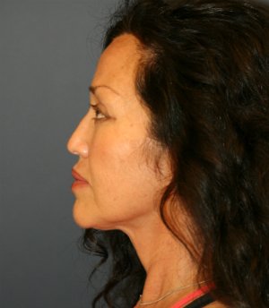 Eyes, Face and Neck - before - side