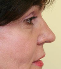 Rhinoplasty Case 1 - before - side