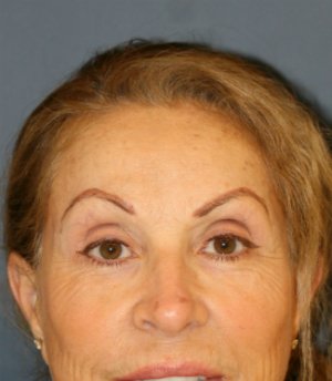 Browlift trans brow - after - front