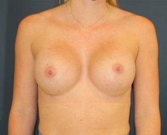 415cc Breast Augmentation - after - front