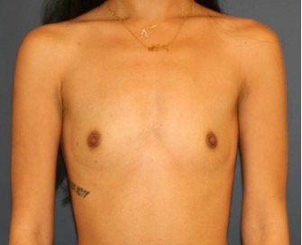 Breast Augmentation 126 - before - front
