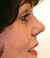 Rhinoplasty Case 1 - after - side