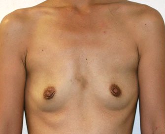 Breast Augmentation Case 28 - before - front